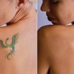 laser tatoo removal