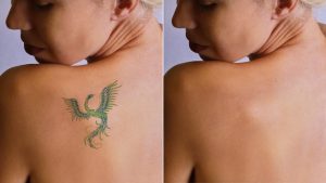 laser tatoo removal