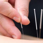 Acupuncture Pickering