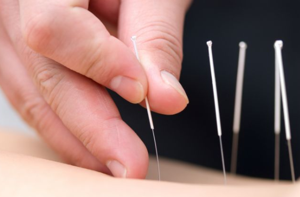 Acupuncture Pickering