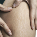 Stretch Marks Treatment