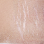 Stretch Marks Treatment Cost