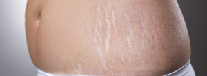 Stretch Marks Treatment Cost