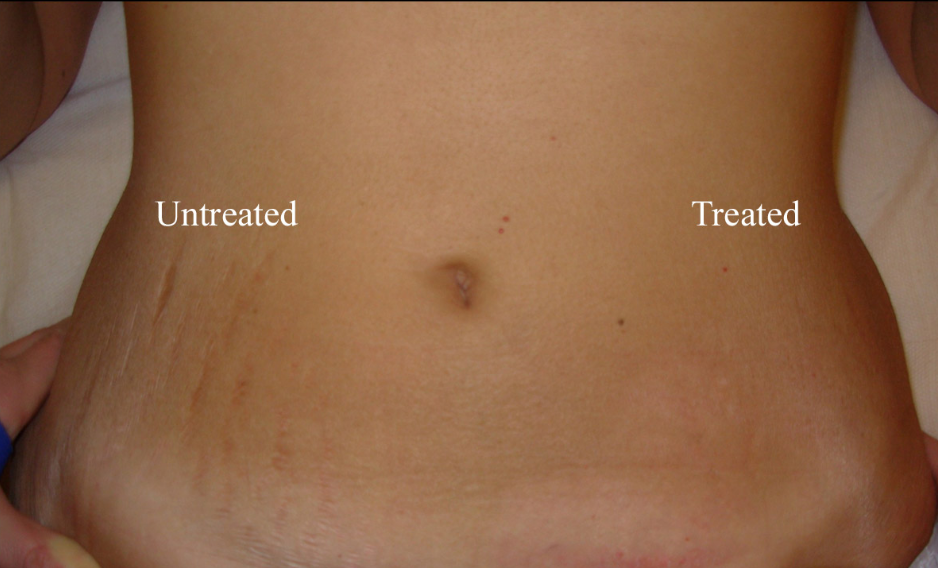 Stretch Marks Treatment Cost