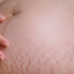 stretch marks treatment