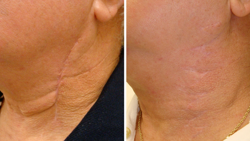 scar removal laser