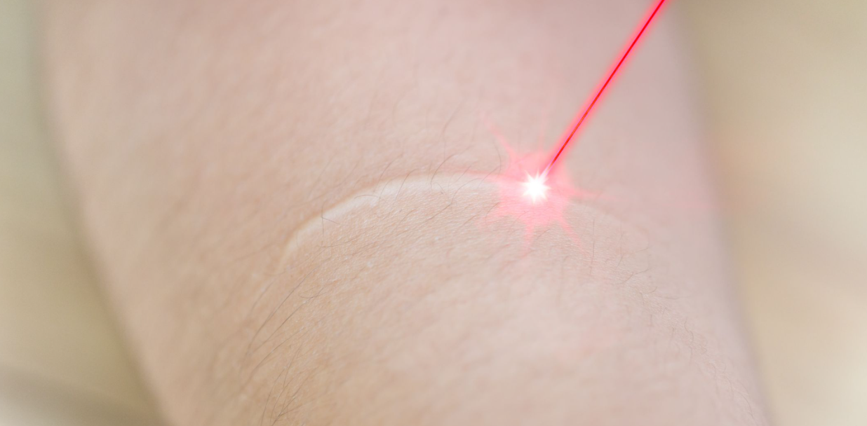 scar removal laser