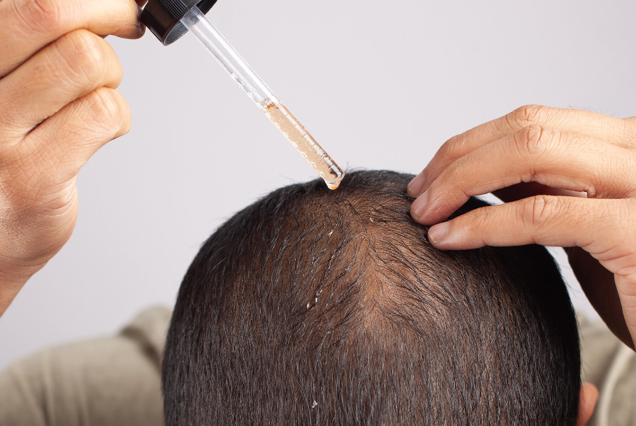 best hair loss treatment in NZ